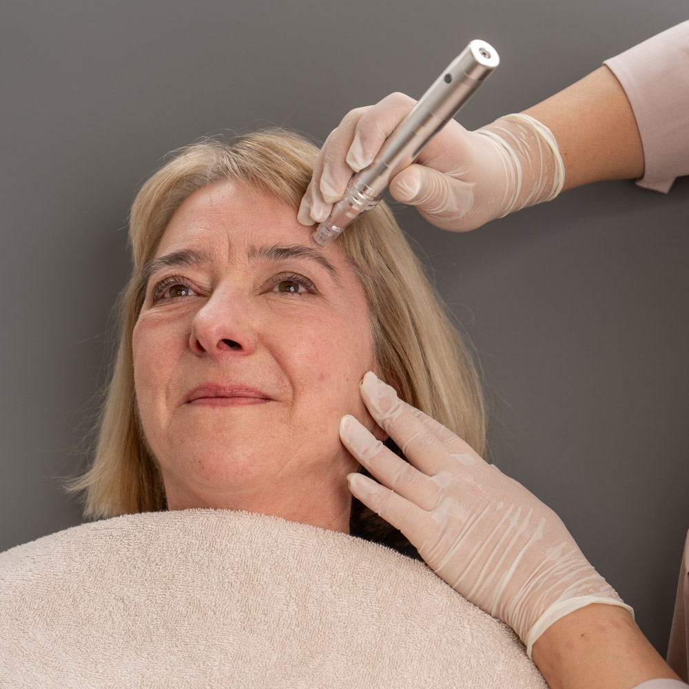 Anwendung von Microneedling und Mesotherapie bei einer Frau im Gesicht